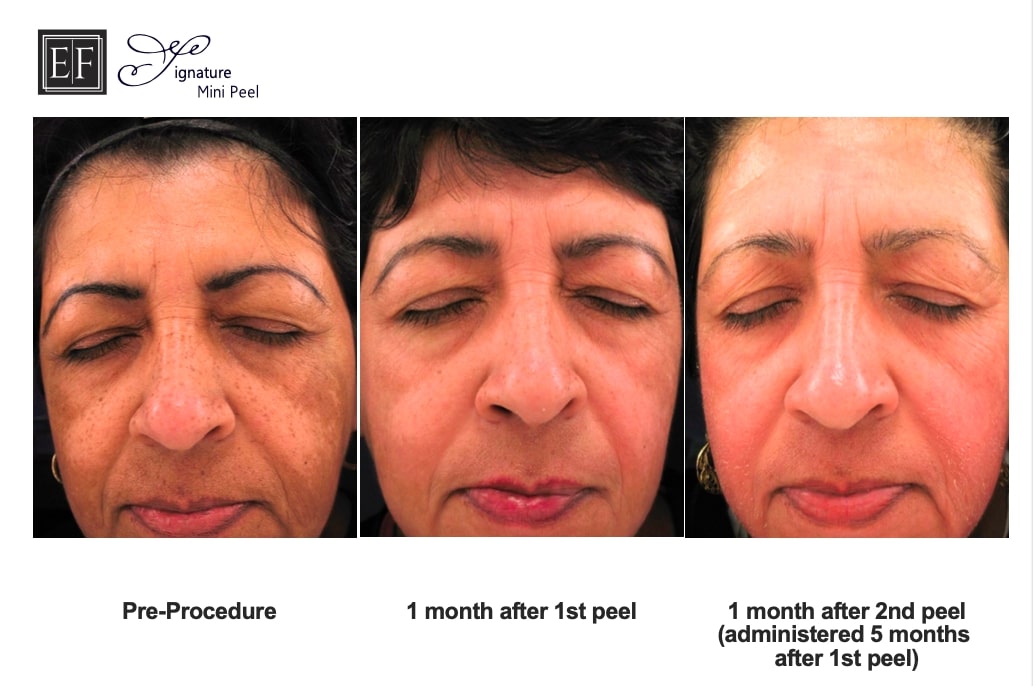 before after for skin peel