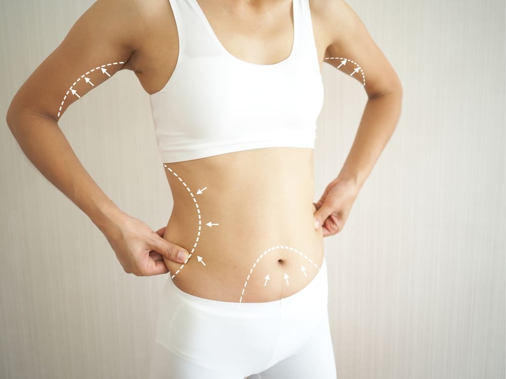 Liposuction San Antonio TX