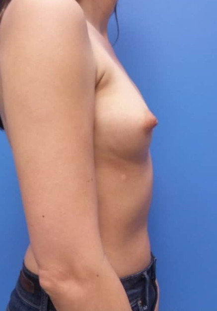 Breast Augmentation