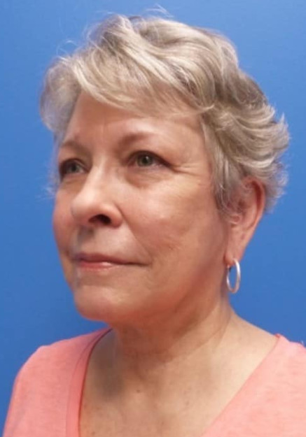 Facelift