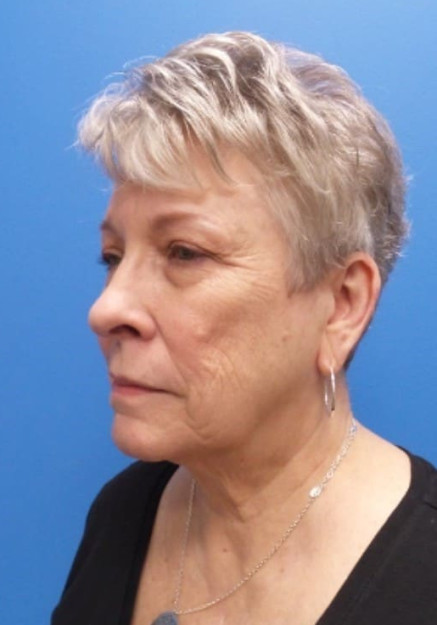 Facelift