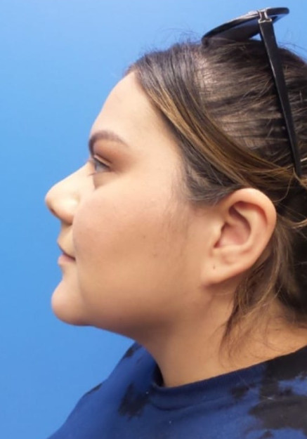 Lipo To Neck