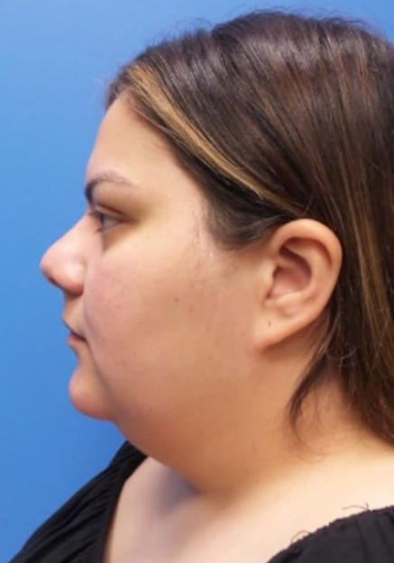 Lipo To Neck