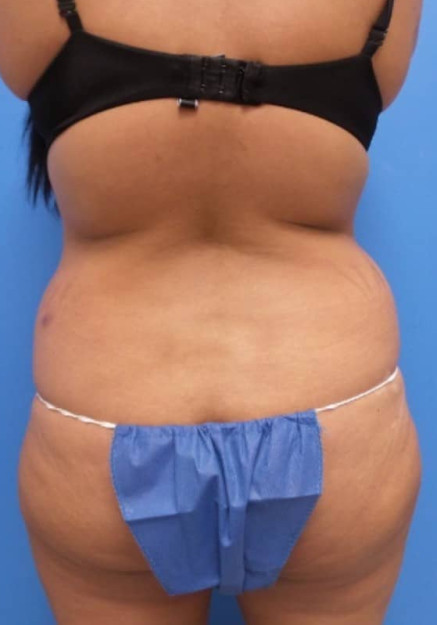 Tummy Tuck & Flank Lipo