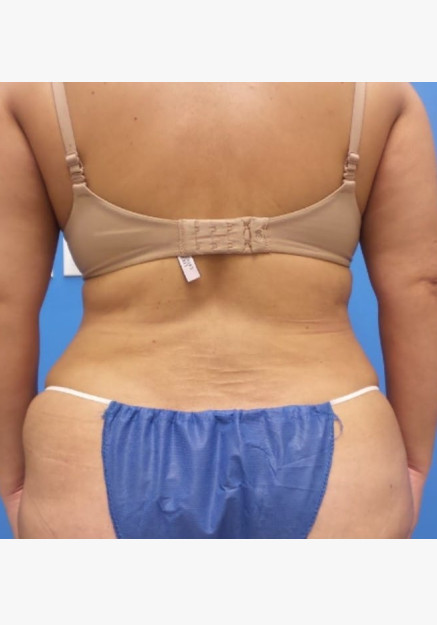 Tummy Tuck & Flank Lipo