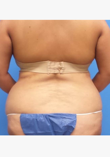 Tummy Tuck & Flank Lipo
