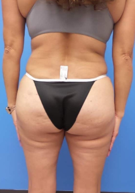 Tummy Tuck & Flank Lipo