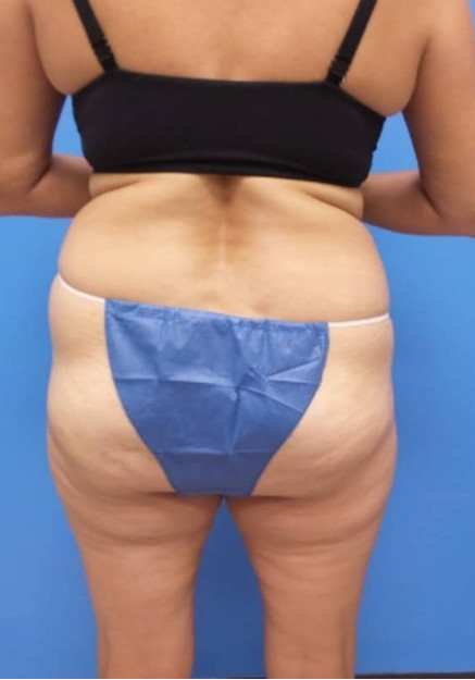 Tummy Tuck & Flank Lipo