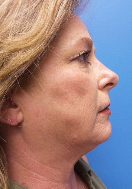 Full Face and Neck Lift