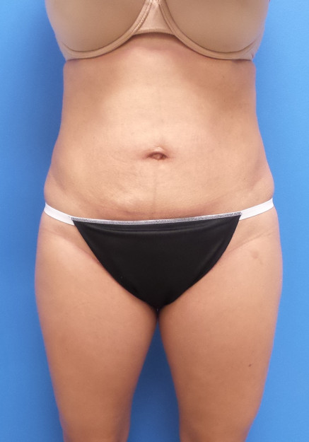 Liposuction – Abdomen Flanks