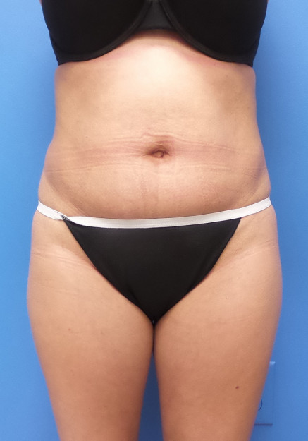 Liposuction – Abdomen Flanks