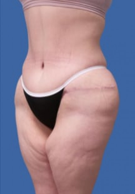 Tummy Tuck Without Liposuction