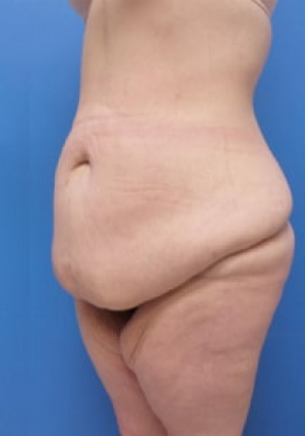 Tummy Tuck Without Liposuction