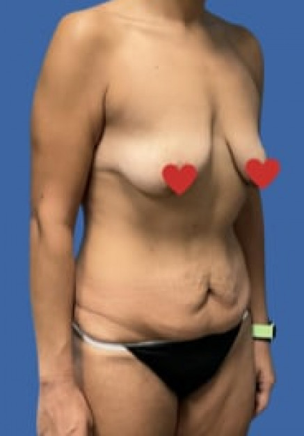 Tummy Tuck with Breast Lift