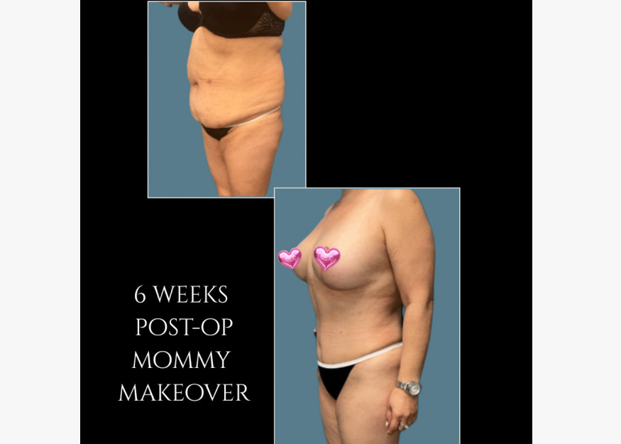 Mommy Makeover