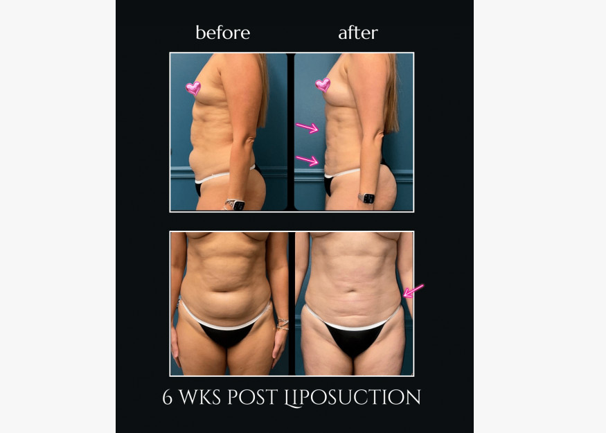 Liposuction